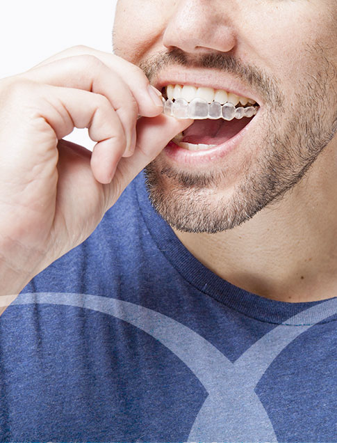 Invisalign : aligner vos dents par gouttière invisible